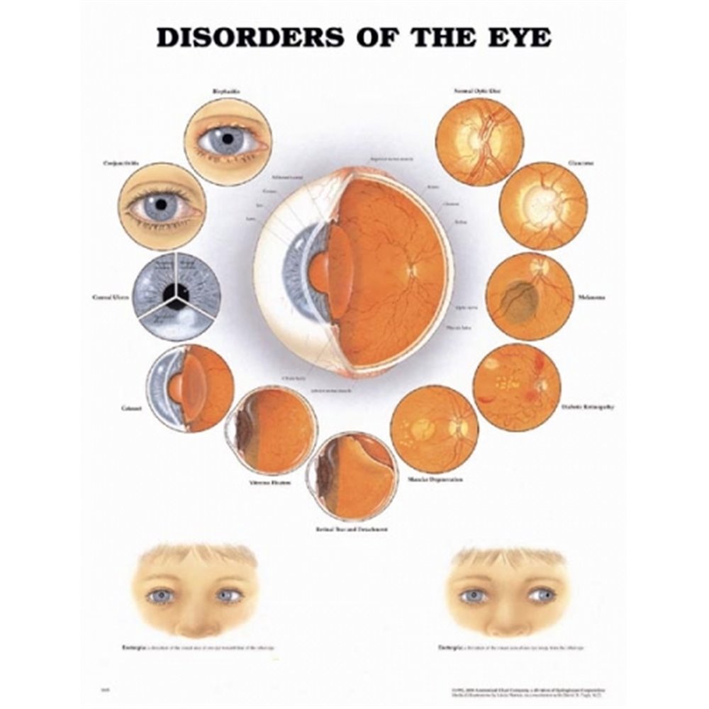 Tablica anatomiczna "Choroby oka"